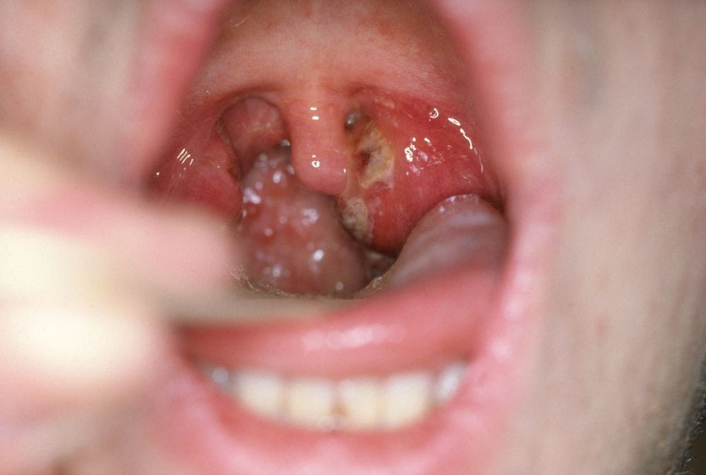 喉咙疱疹怎么治疗图片