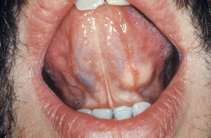 c0144405-sublingual-salivary-tumor-science-photo-library-high_zh