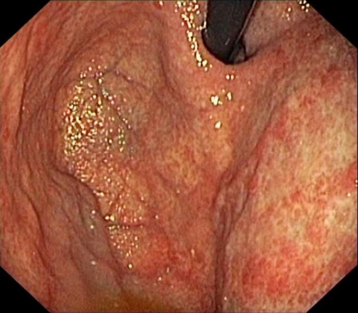c0163897-atrophic-gastritis-endoscope-view-science-photo-library-high_zh