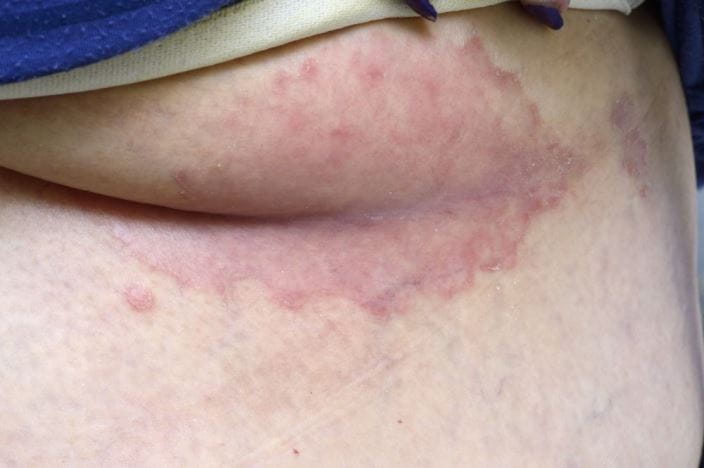 c0166868-inverse-psoriasis-science-photo-library-high_zh