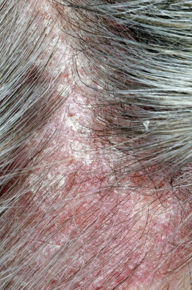 c0169279_psoriasis_on_the_scalp_science_photo_library_high_zh