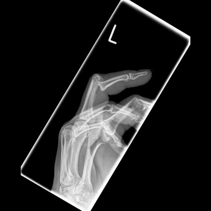 c0177183_volar_finger_dislocation_science_photo_library_high_zh