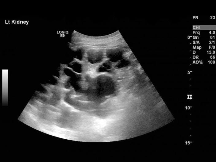 c0177189-polycystic-kidney-disease-ultrasound-science-photo-library-high_zh