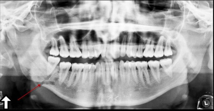 C0177557-fracture-of-angle-of-mandible-x-ray-science-photo-library-arrow-high_zh
