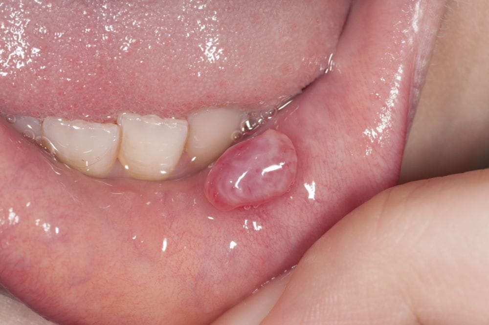 口腔粘液腺瘤图片图片
