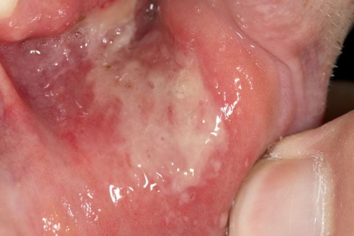 c0213332-major-aphthous-ulcer-science-photo-library-high_zh