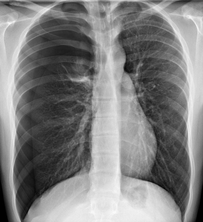 c0217945_pneumothorax_x-ray_science_photo_library_high_zh
