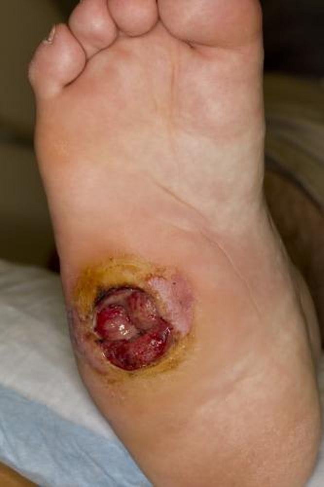 c0220501-foot-pressure-ulcer-science-photo-library-high_zh