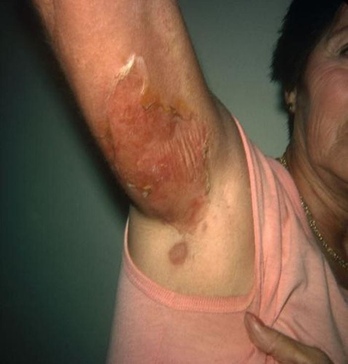 c0222124-staphylococcal-scalded-skin-syndrome-adult-science-photo-library-high_zh