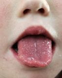 舌头表面变化