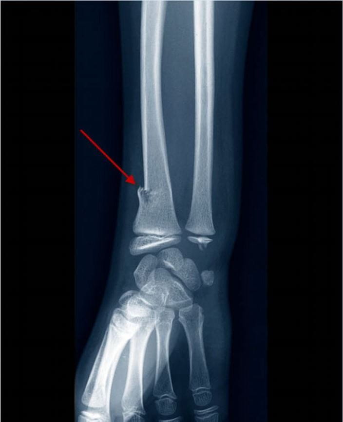C0267934-greenstick-fracture-of-distal-radius-x-ray-science-photo-library-arrow-high_zh
