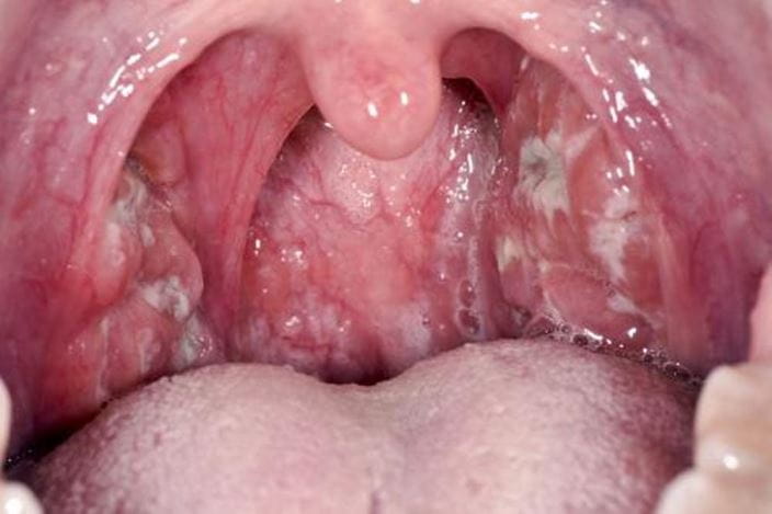 c0269170-streptococcal-tonsillitis-science-photo-library-high_zh