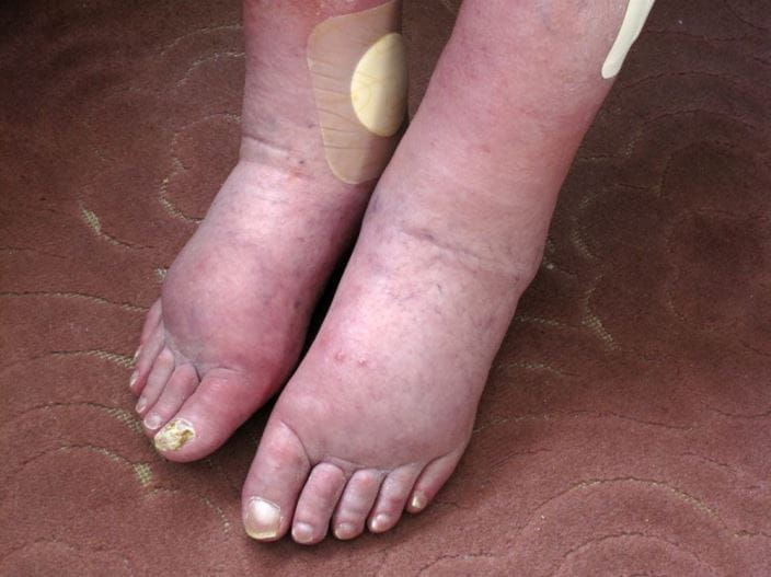 c0271080-lower-extremity-edema-science-photo-library-high_zh