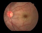 视网膜中央动脉阻塞和分支动脉阻塞