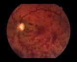 视网膜中央静脉阻塞和分支静脉阻塞