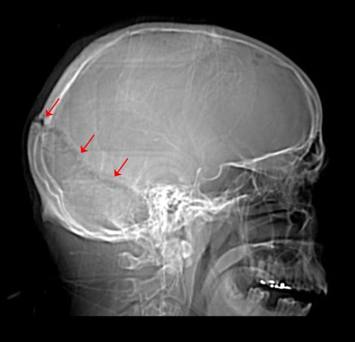 c0271705-skull-fracture-science-photo-library-high_zh