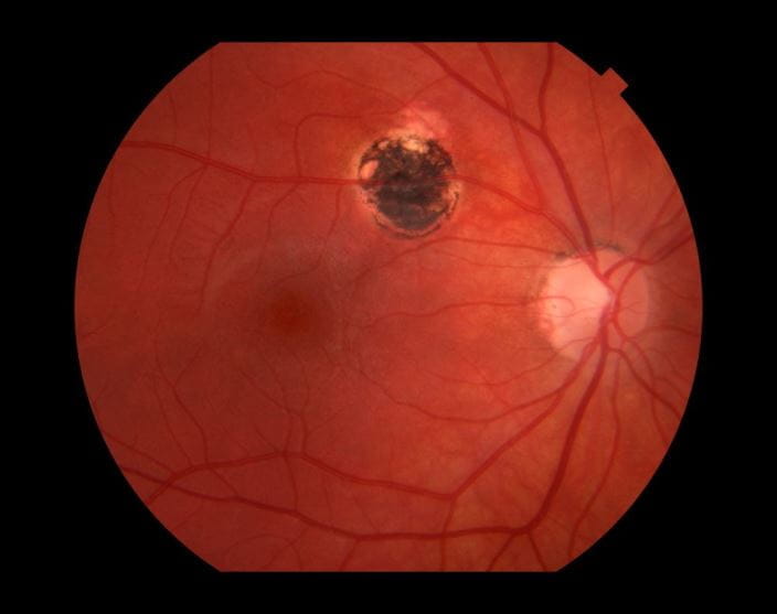 c0271978-retinitis-toxoplasmosis-science-photo-library-high_zh