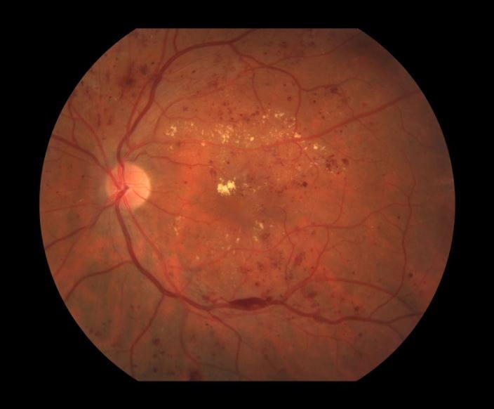 c0272524-diabetic-retinopathy-nonproliferative-science-photo-library-high_zh