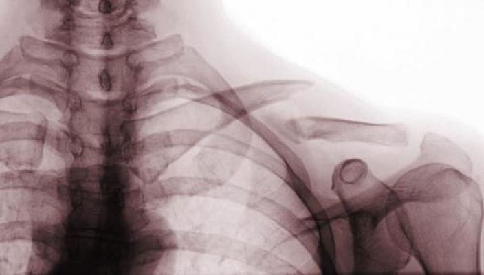 c0272620-clavicle-fracture-x-ray-science-photo-library-high_zh