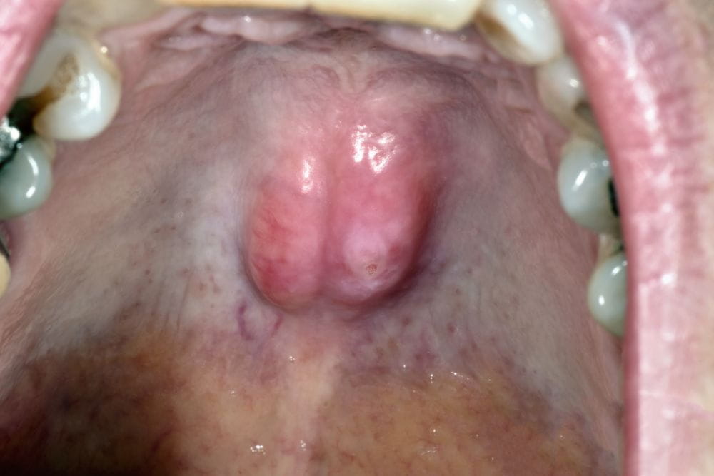 腭咽弓癌早期症状图片图片