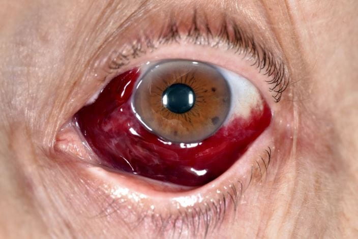 c0284480-subconjunctival-hemorrhage-science-photo-library-high_zh