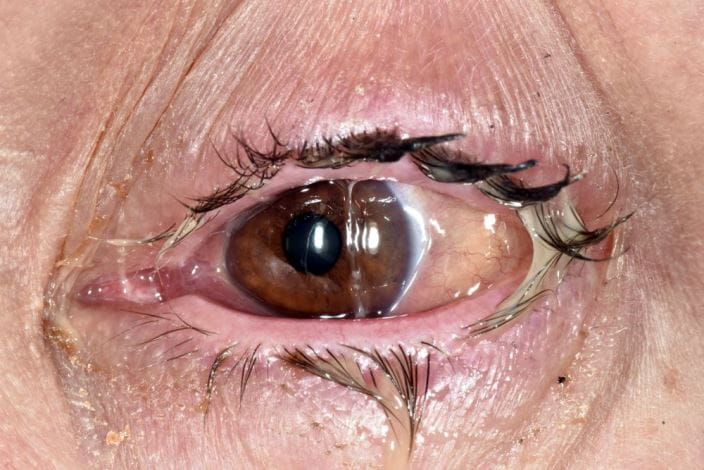 c0284481-bacterial-conjunctivitis-science-photo-library-high_zh