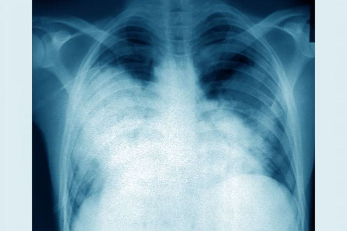 c0333011-legionnaire-disease-chest-x-ray-science-photo-library-high_zh
