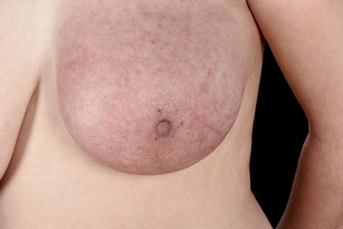 c0333618-breast-cancer-science-photo-library-high_zh