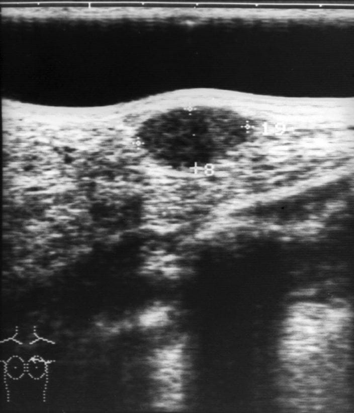 c0337371-ultrasound-of-a-breast-lump-science-photo-library-high_zh