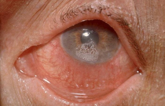 c0365797-ocular-burn-chemical-science-photo-library-high_zh