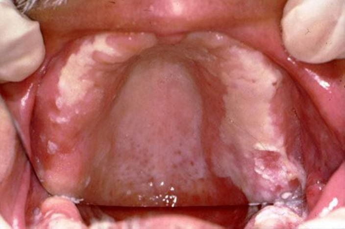 candidial_stomatitis_high_zh