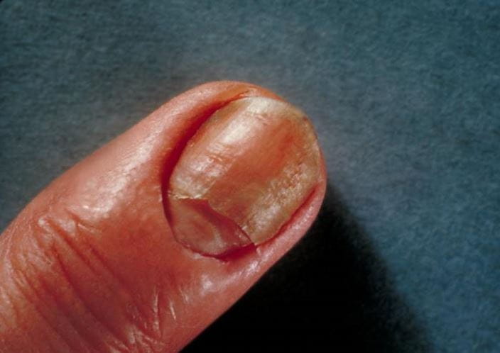 candidiasis_nail_infection_zh