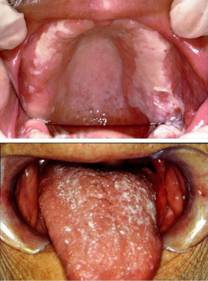 candidiasis_oral_high_zh