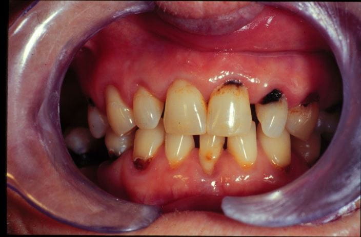 caries_on_examination_orig_zh