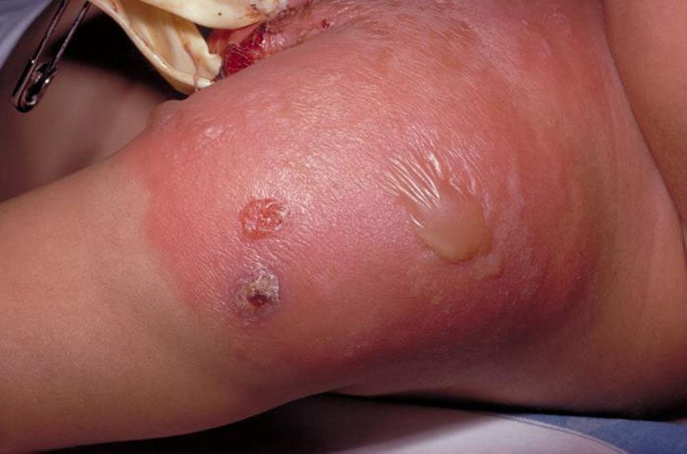 关键点治疗预后诊断症状和体征病因蜂窝织炎是一种急性的皮肤和皮下