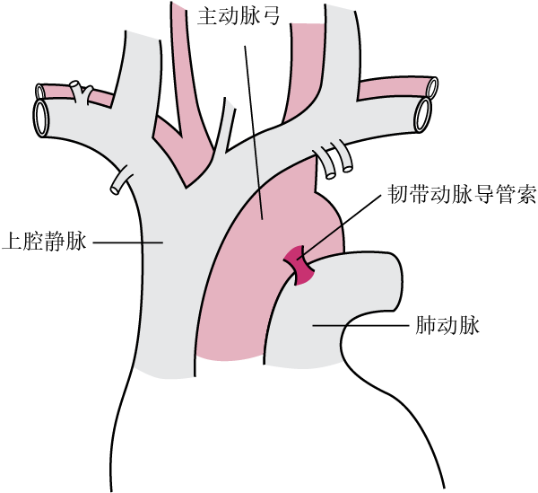 主动脉部分破裂多发生于动脉韧带附近