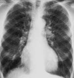 慢性阻塞性肺病（COPD）