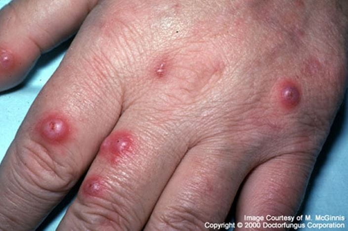 cryptococcosis_disseminated_high_zh