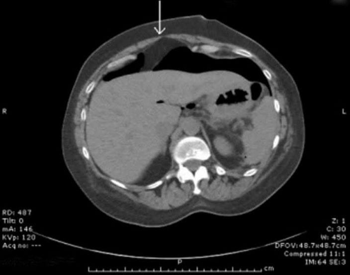 CT-with-free-peritoneal-air-ansari-sized_zh