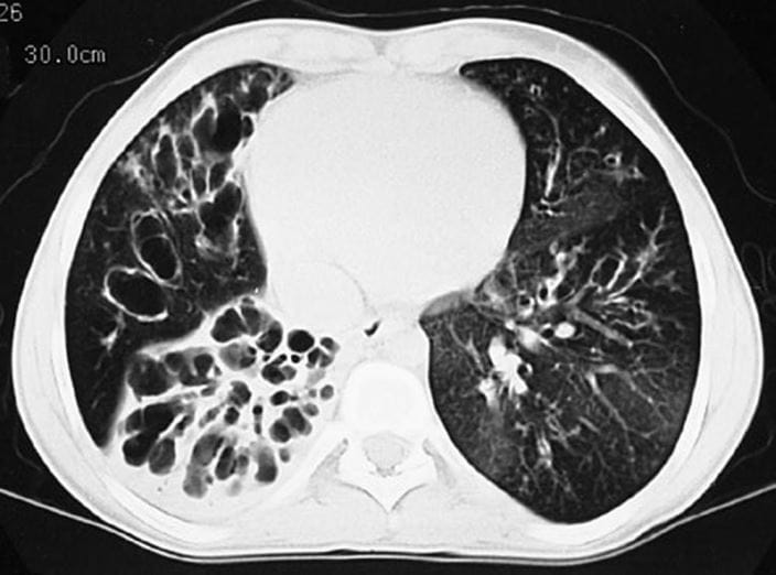 cystic_fibrosis_ct_scan_high_zh