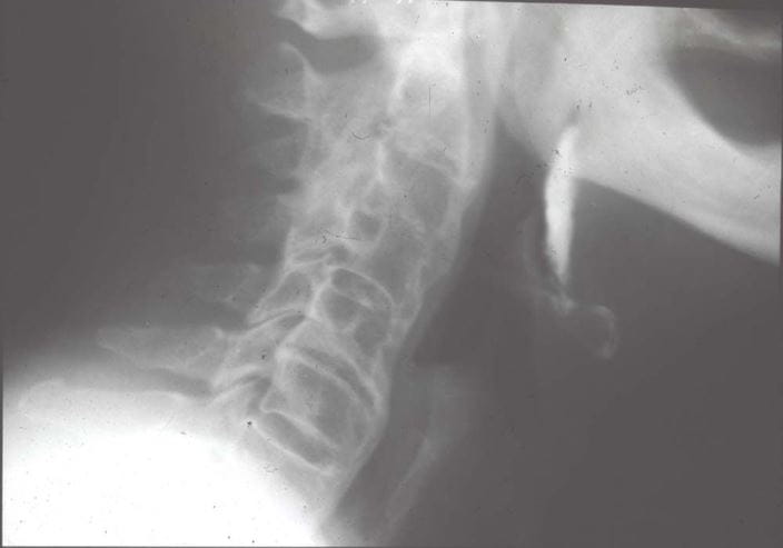 diffuse_idiopathic_skeletal_hyperostosis_dish_orig_zh