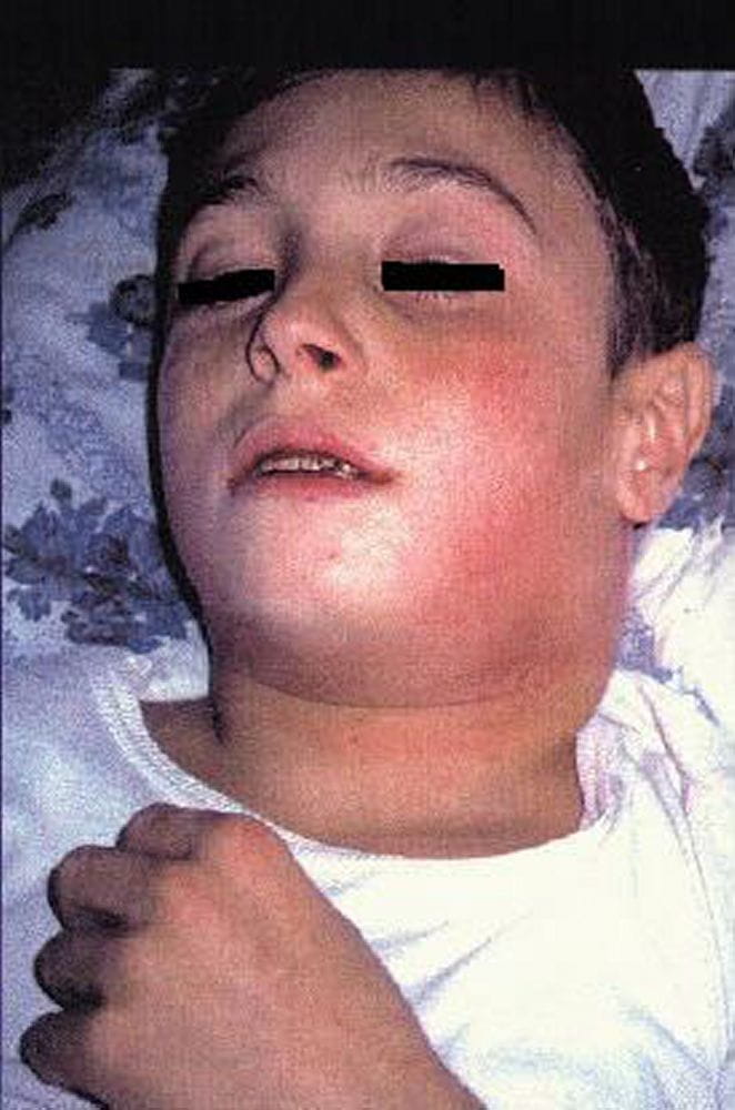 diphtheria_nasopharyngeal_with_bull_neck_high_zh