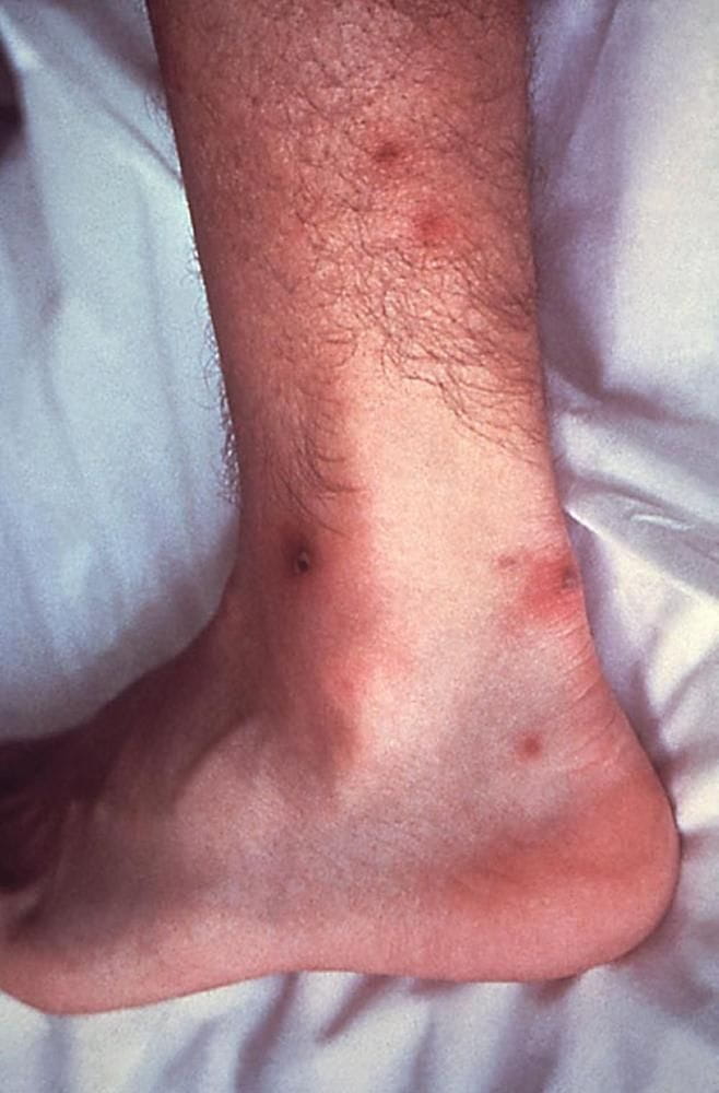 disseminated_gonococcal_infection_skin_lesions_high_zh