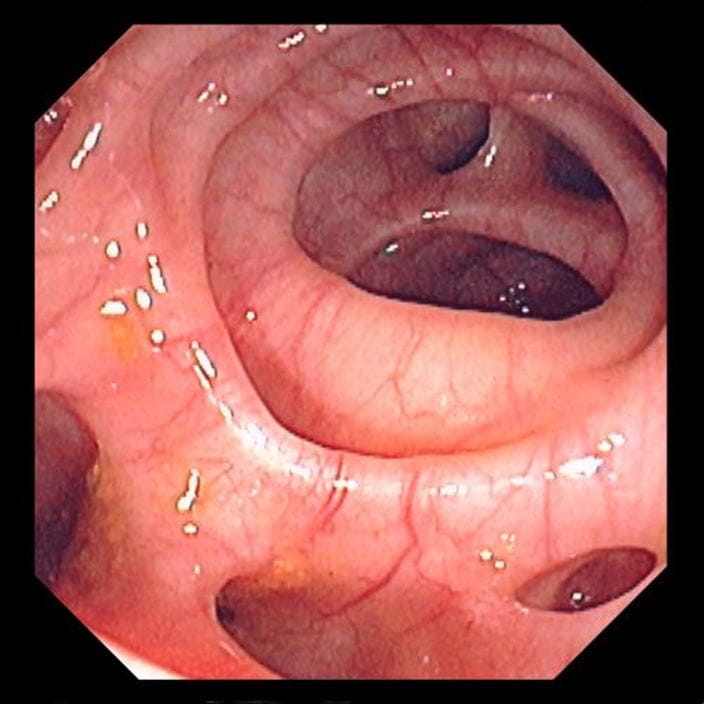 diverticulosis_high_zh