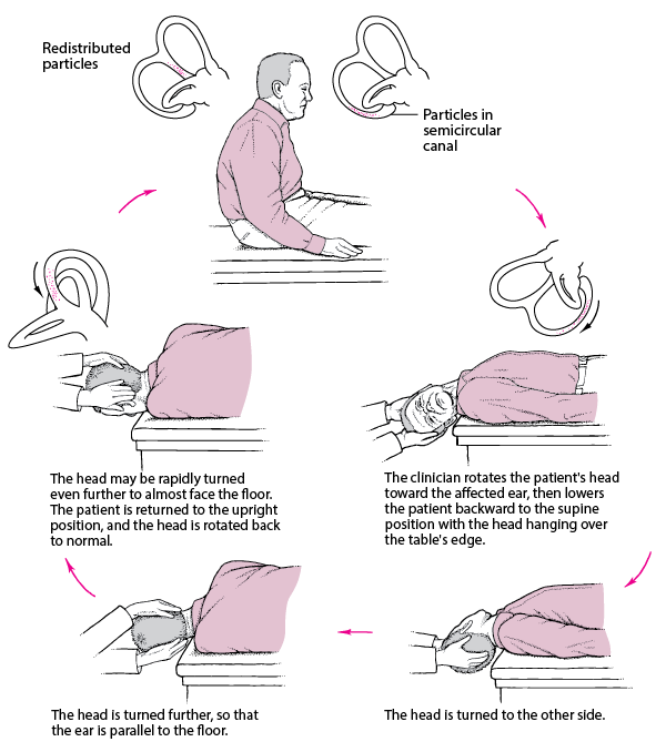 Epley动作：一种治疗常见眩晕的简单方法