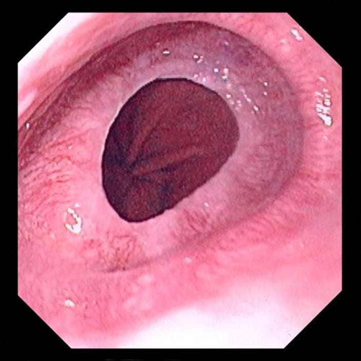 esophageal_ring_high_zh