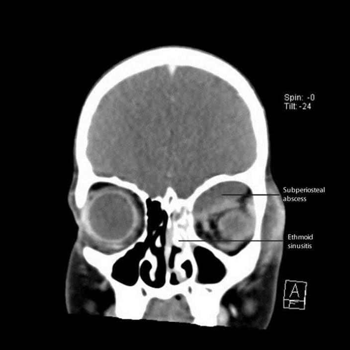 ethmoid_sinusitis_with_subperiosteal_abscess_labels_zh