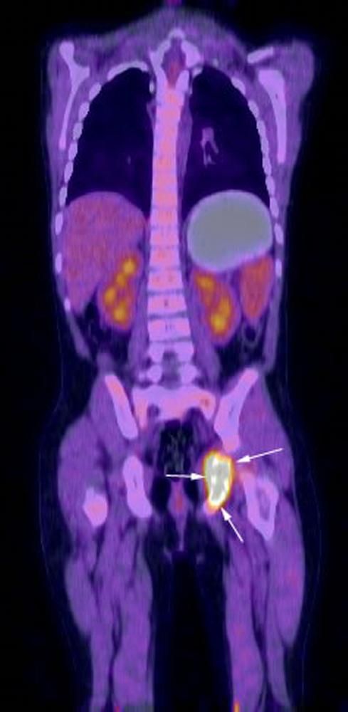 FDG_PET_CT_reconstruction_histiocytosis_high_zh
