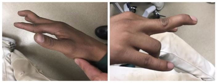 finger-dislocation-A-and-B-joined_zh