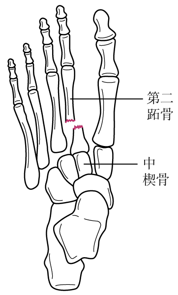 跖骨骨折解剖图图片